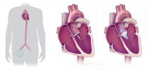 Derince Araştırma'da ameliyatsız kalp kapak değişimi