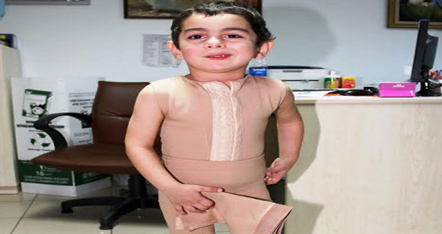 Süt kazanına düşen Berat iyileşecek