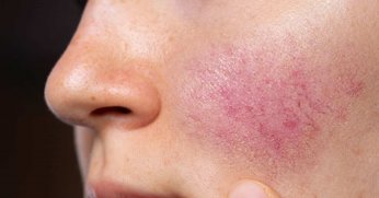   Yüzünüzdeki Kızarıklığın Nedeni Gül Hastalığı Olabilir